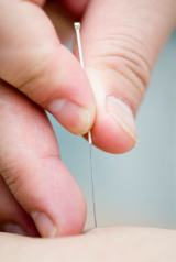 Acupuncture